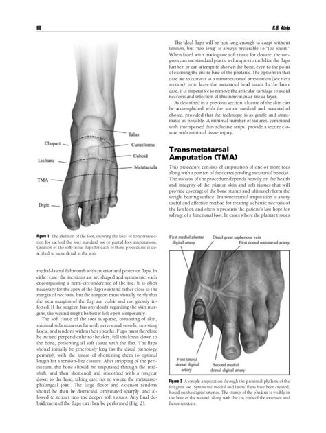 227-14 (June. . Phalangectomy of three toes cpt codes